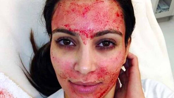 Three women infected with HIV after ‘vampire facials’