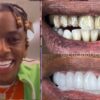 Soulja Boy getting veneers saved his life