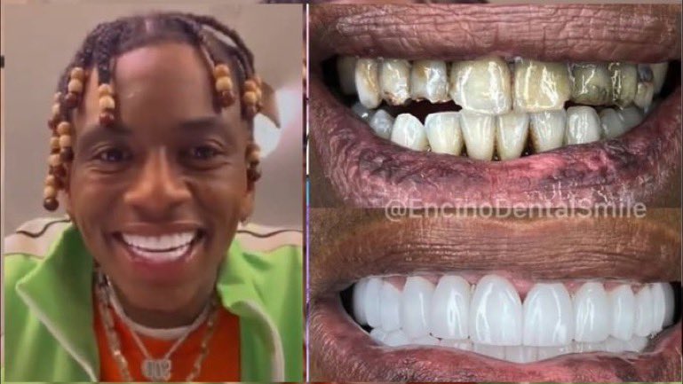 Soulja Boy getting veneers saved his life